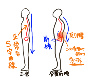 骨盤が前に傾いた状態で直立しようとすると、腰椎（腰の骨）が反って変形していきます。